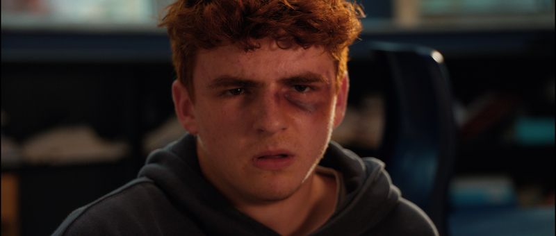 Close on a teenage boy with a bruised eye, looking off camera.
